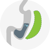 Sleeve Gastrectomy icon