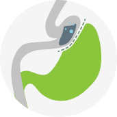 Gastric Bypass Surgery icon